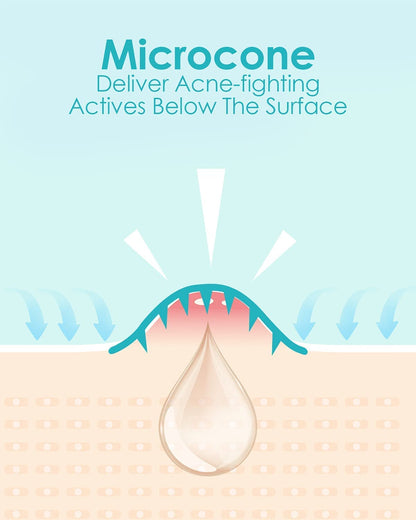 Microdart Acne Patch (36 Patches) - Hyaluronate Acid & Salicylic Acid Hydrocolloid Pimple Patch for Deep, Early and Hidden Blemishes (36 Count (Pack of 1))