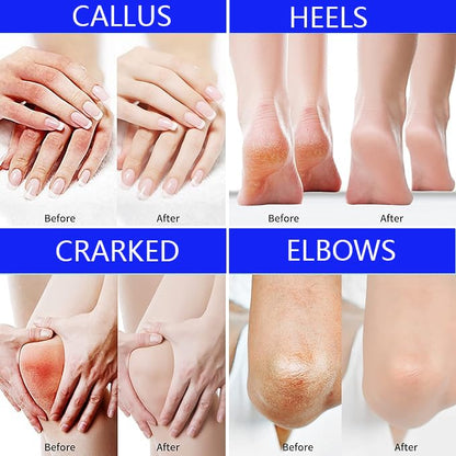 Urea Cream foot cream, 40 percent Foot Care Lotion for Cracked Heels,Moisturizing，Cracked Heels, Ultra,Rough, Dry, Calloused Feet,Softening Rough skin on feet for All Skin 5.29 fl.oz