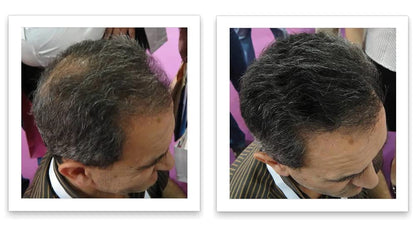 Caboki Hair Loss Concealer. All-Natural Hair Building Fiber. Make Thin Hair Look 10X Fuller Instantly. Eliminate the Appearance of Bald Spot and Thinning Hair (30G, 90-Day Supply). Salt & Pepper-Dark