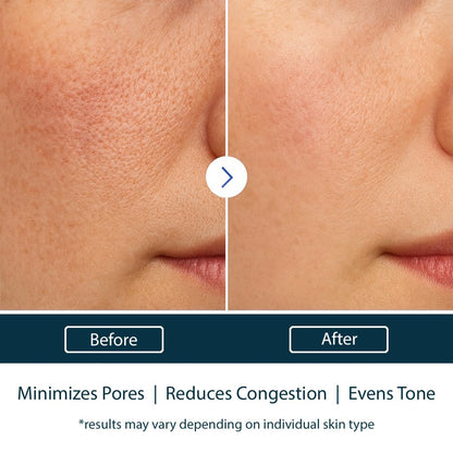 NAELI AHA/BHA Exfoliating Face Wash - 10% Glycolic Acid & Salicylic Acid Cleanser, Anti Aging Acne & Wrinkle Reducing Facial Exfoliant, Pore Minimizer & Brightening Gel, 6 oz