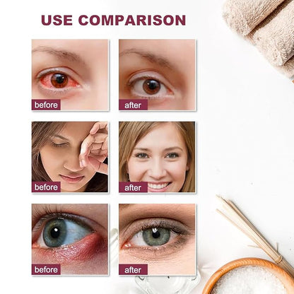 Stye eye treatment,chalazion remover,stye eye