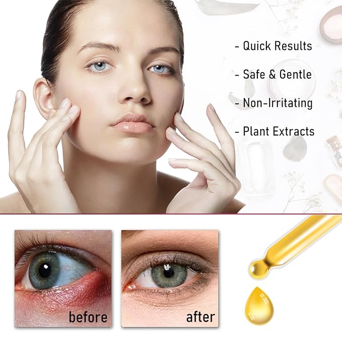 Stye eye treatment,chalazion remover,stye eye