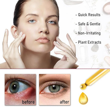 Stye eye treatment,chalazion remover,stye eye