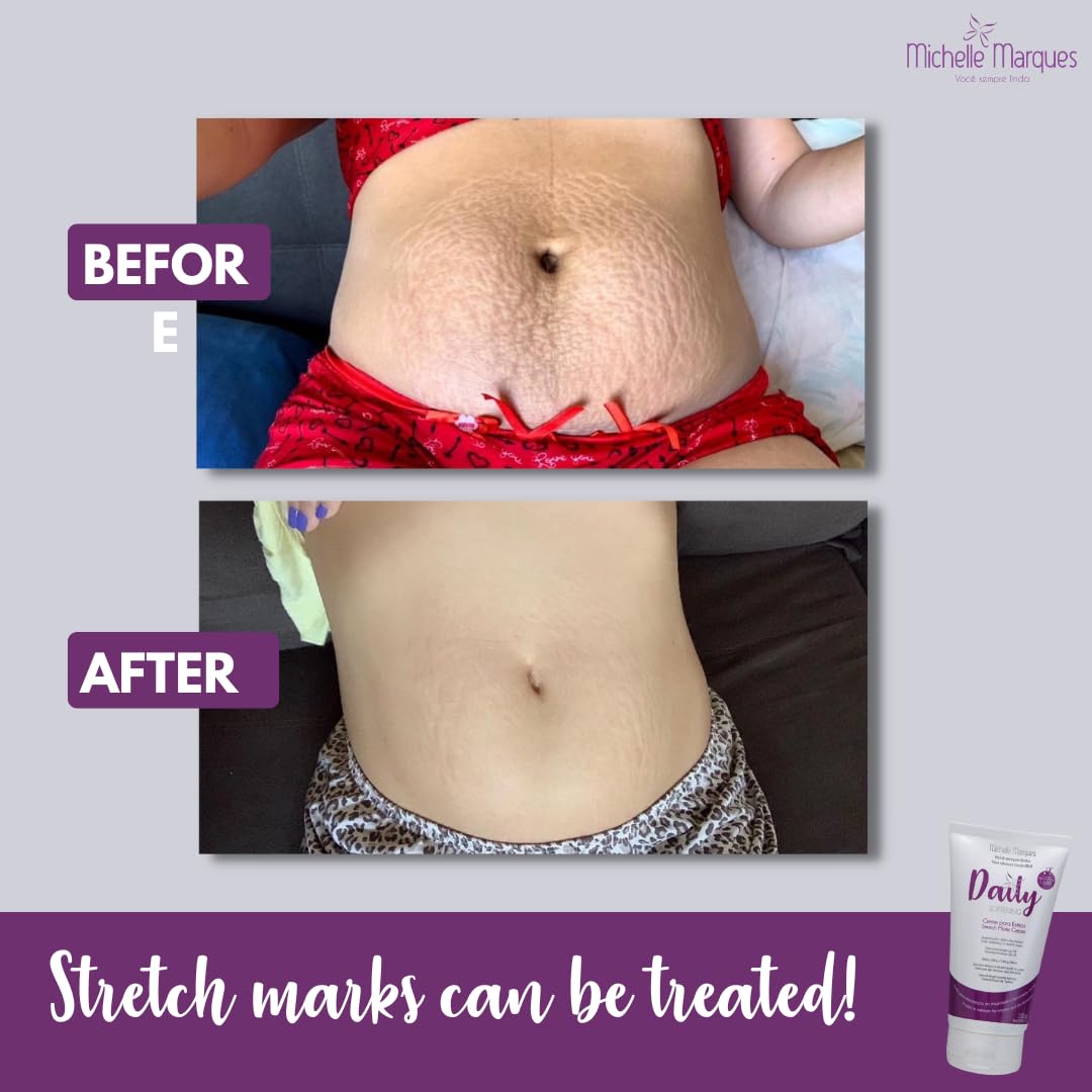 Stretch Mark Cream, Soften and Reduce the Appearance, Provides Hydration, and Improves Skin Elasticity and Texture, 5.29oz