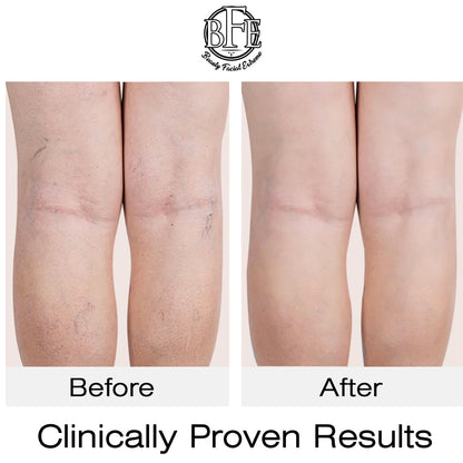 Vitamin K Cream- Moisturizing Bruise Healing Formula. Dark Spot Corrector for Bruising, Spider Veins & Broken Capillaries. Reduces Under Eye Dark Circles, Fine Lines, Puffiness, & Wrinkles.