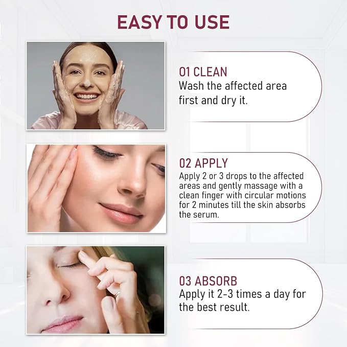 Stye eye treatment,chalazion remover,stye eye