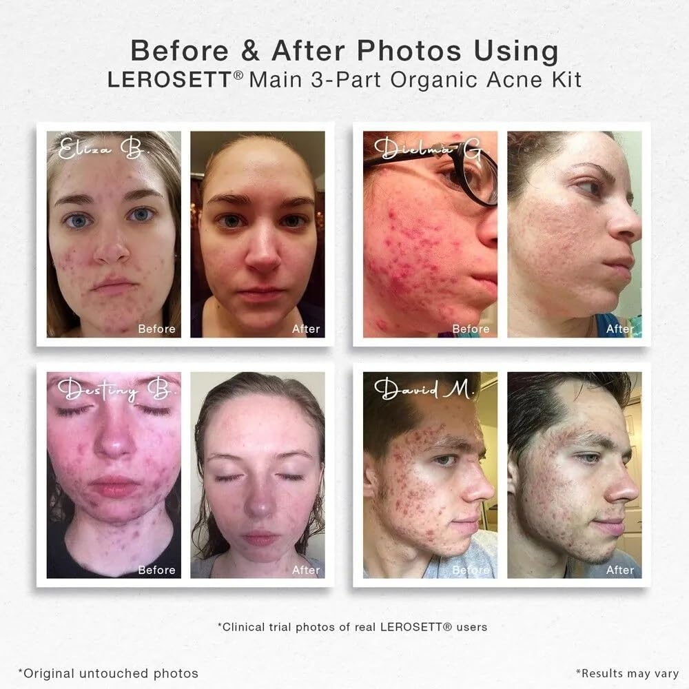 LEROSETT Acne Kit Includes Cleanser Moisturizer & Spot Treatment Mask Organic Calming Aloe & Clay Based, Clears Acne, Pimples, Blackheads & Breakouts, Vegan Acne Kit, For All Skin Types