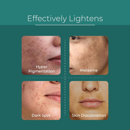 Pure & Cimple Probiotic Skin Brightening Serum | Dark Spot Face Treatment | Age Spots | Melasma, Sun Damage and Dark Pigmentation Remover | Brighter Skin Tone | Fragrance-Free