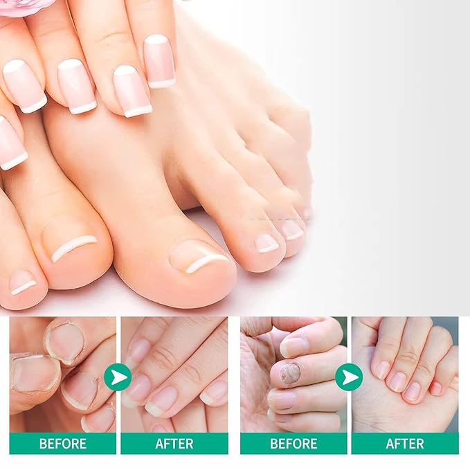 2pcs Herbal Nail Treatment Essence,Rosabelle