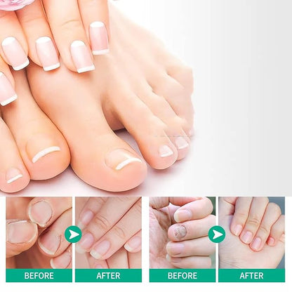 2pcs Herbal Nail Treatment Essence,Rosabelle