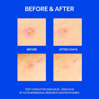 Right Away Thincognito Invisible Spot Patch - Absorbing Hydrocolloid Pimple Patch for Face, Blemishes, Zits, Acne, Breakouts Spot Treatment for Skin Care, 2 Sizes (42 Count Pack of 2)