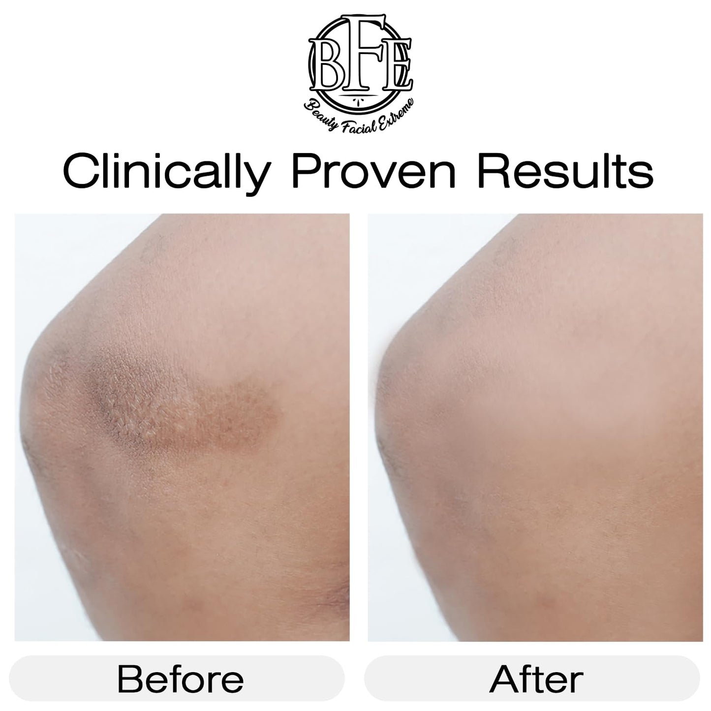 Vitamin K Cream- Moisturizing Bruise Healing Formula. Dark Spot Corrector for Bruising, Spider Veins & Broken Capillaries. Reduces Under Eye Dark Circles, Fine Lines, Puffiness, & Wrinkles.