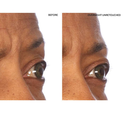 SiO Beauty SuperLift Forehead, Eye, & Lip Anti-Wrinkle Silicone Patches - Reduce Brow, Smile, and Under Eye Wrinkles Overnight