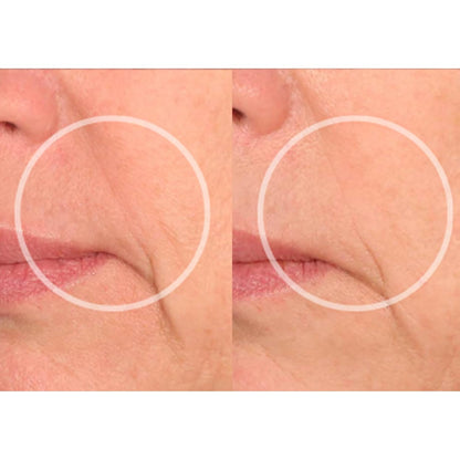 SiO Beauty Eye & Smile Lift - Eye & Smile Anti-Wrinkle Patches 2 Week Supply - Overnight Smoothing Silicone Patches for Wrinkles and Fine Lines