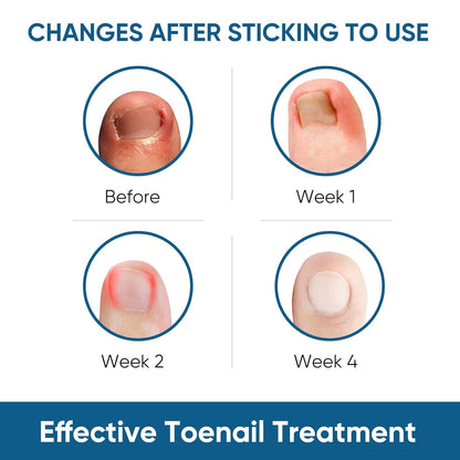 Ingrown Toenail Treatment, 60Pcs Ingrown Toenail Corrector Strips, Ingrown Toenail Removal Kit with File and Lifter, 60Pcs