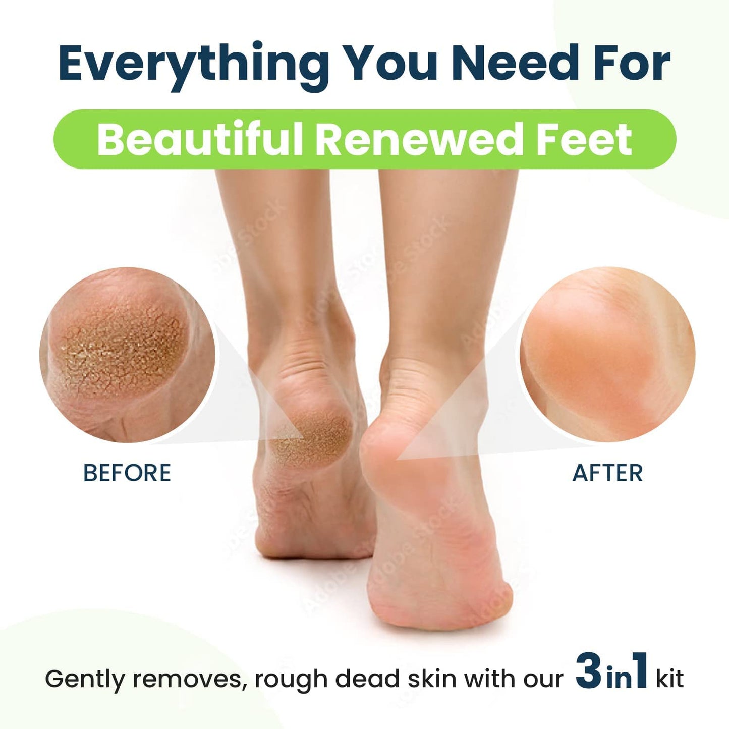 Callus Remover for Feet with Extra Strength Gel & Foot Pumice Stone Set - Easy Way to Remove Hard Calluses & Dead Skin Build-Up - Professional At-Home Foot Care for Men & Women - Made in the USA