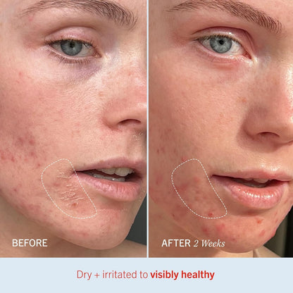 First Aid Beauty - Ultra Repair Cream, Intense Hydration Whipped Colloidal Oatmeal, Clinically Proven to Strengthen Skin Barrier & Help Relieve Eczema, Face & Body Moisturizer, 14oz Fresh Strawberry