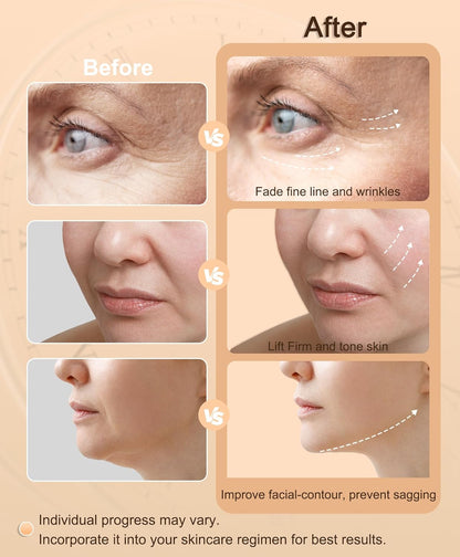 Radio Frequency Skin Tightening Device | 6 in 1 Home RF Face Beauty Device | Professional Facial Skin Tightening | Lifting | Wrinkle Reducing | Anti Aging | Depuff | Increase Absorption(with Gel)