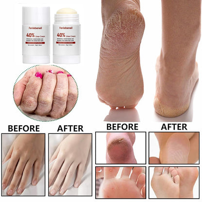 40% Urea Cream Cracked Heel Balm for Dry, Cracked Feet, Heals, Foot Hand Moisturizing 40 Percent Foot Urea Cream for Feet Maximum Strength 2Pack