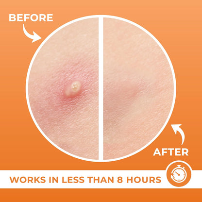 Acne Patches (120 Count), Hydrocolloid Pimple Patches for Face - Zit Patch Acne Dots - Cystic Acne Patches Treatment - Pimple Patch with 3 Size Acne Stickers