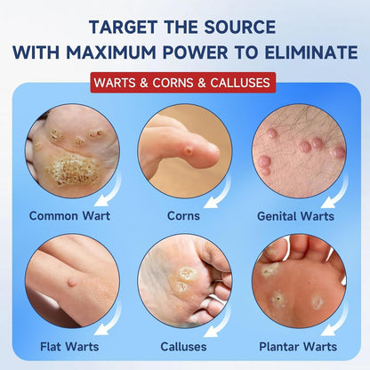 Fast-Acting Skin Tag Remover Wart Remover with Salicylic Acid, Wart Removal for Women Men, Wart Freeze Off for Plantar Wart, Flat, Common, Corn,H Wart, Callus 30ML