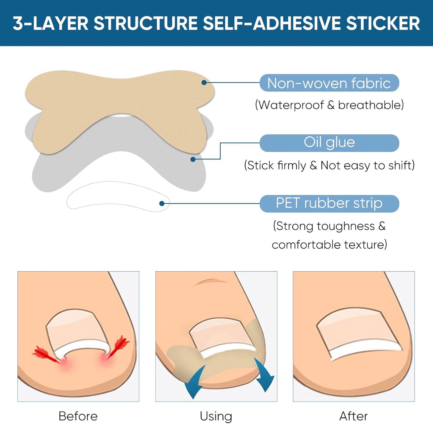 Ingrown Toenail Treatment, 60Pcs Ingrown Toenail Corrector Strips, Ingrown Toenail Removal Kit with File and Lifter, 60Pcs