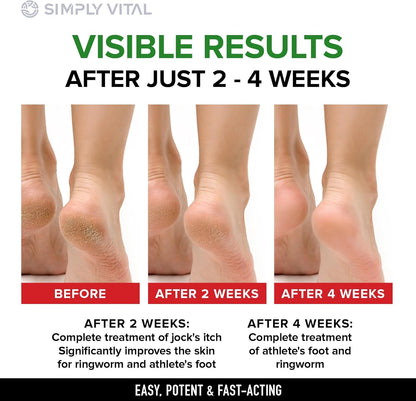 SimplyVital Antifungal Cream with Clotrimazole 1% - Foot Skin Fungus Treatment Extra Strength for Humans - Anti fungal Treatment for Ringworm, Jock Itch & Athlete’s Foot – Made in USA – 2 oz