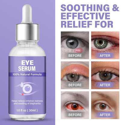 Eye Serum, Mild Eye Treatment for Styes Chalazḭon and Blepharḭtis Ṫreatment, Natural Lash and Eye Cleanser- Regain Healthier Eye Skin, 1 Fl.oz