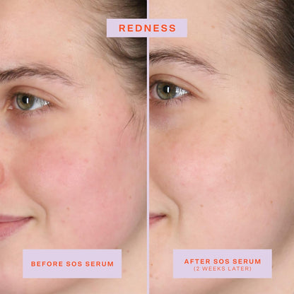 Tower 28 SOS Intensive Rescue Serum for Sensitive Skin, Hypochlorous Acid Skin Care, Helps Reduce Face Redness, Safe for All Skin Types, 2 FL Oz