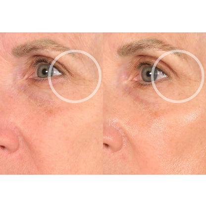 SiO Beauty Eye & Smile Lift - Eye & Smile Anti-Wrinkle Patches 2 Week Supply - Overnight Smoothing Silicone Patches for Wrinkles and Fine Lines