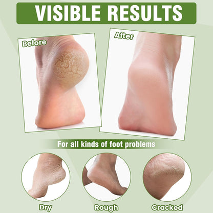 18 Pairs Moisturizing Foot Masks with Shea Butter, Jojoba Oil, Vitamin E & Urea, Intensely Hydrating Foot Mask For Dry Cracked Feet, Moisturizing Socks for Cracked Heel Treatment