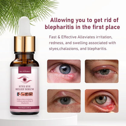Stye eye treatment,chalazion remover,stye eye