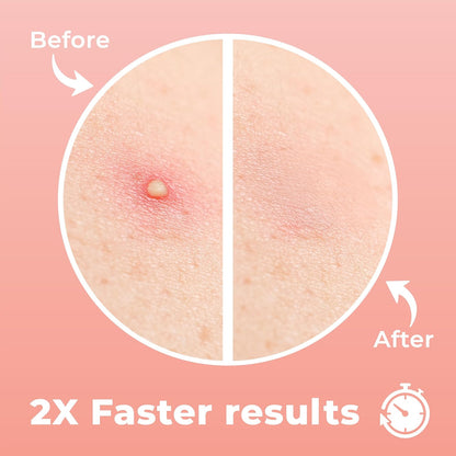 Micro Needle Pimple Patch (18 Pack) - Hydrocolloid Micropoint Pimple Patch For Acne & Pimples, Eliminate Pimples Overnight, Microdart Patch, Micro Dart Pimple Patches