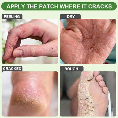 25PCS Aloe Vera Cracked Heel Treatment Patches, Cracked Heel Repair Bandage (Rectangular)