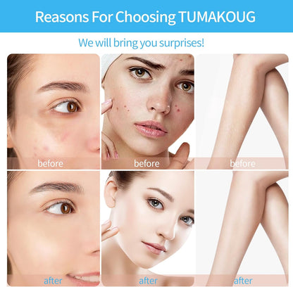 High Frequency Facial Machine-Portable Handheld Skin Therapy Wand High Frequency for Hair with 4 Different Tubes