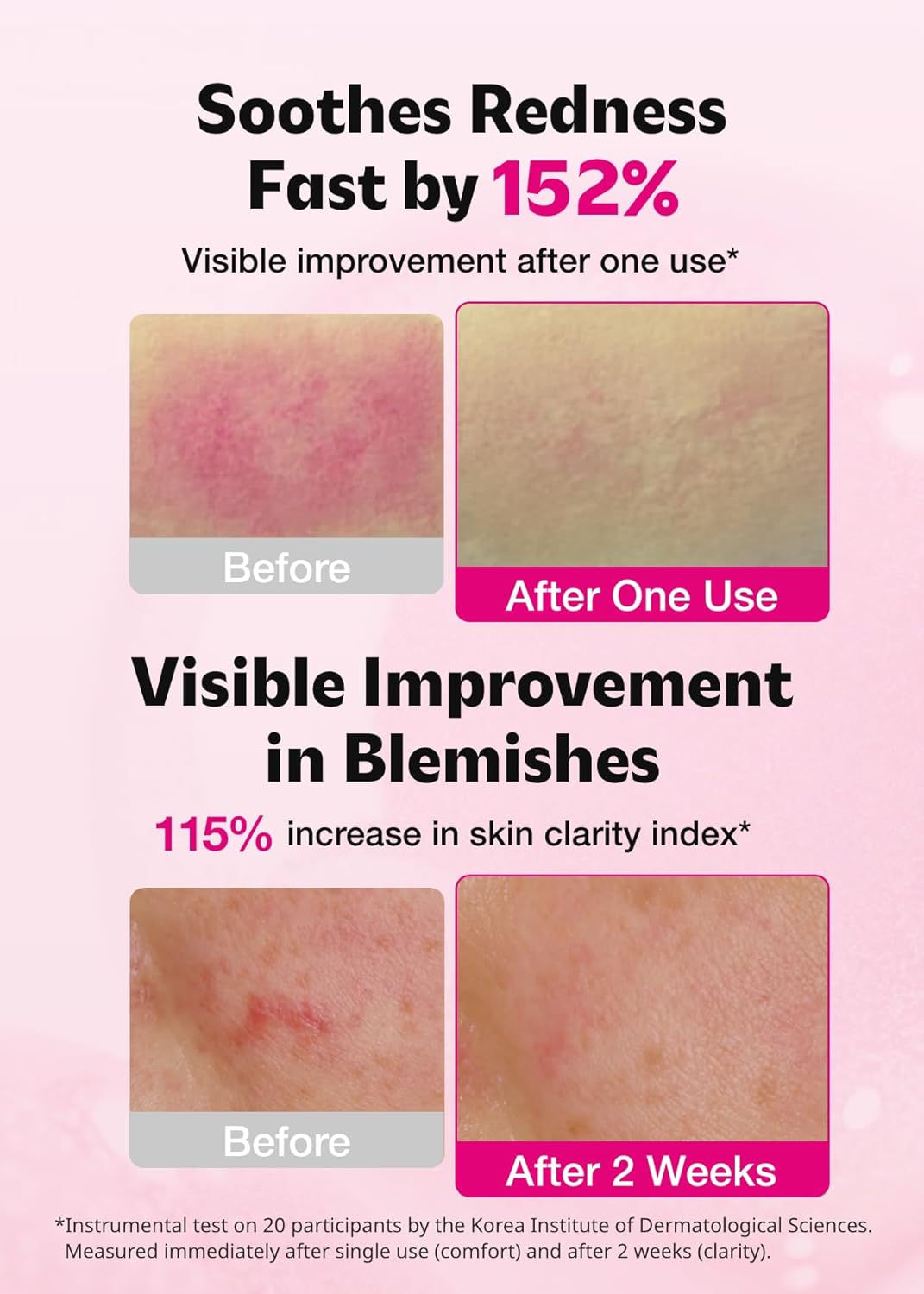 ISOI Blemish Care Up Serum for Face, Vegan Hydrating Serum for Smooth & Glass Skin Effect, Skin Barrier & Moisture Balance for Women, Arbutin, Korean Skin Care (2.36 fl. oz, 70ml)