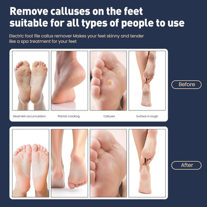 Electric Foot Callus Remover,2 in1 Rechargeable Callus Remover for Feet,9-Speed Cordless Electric Foot File Nail Grinder,Foot Scrubber Pedicure Tools for Dead Skin Dry Cracked Feet(Fold Gold)