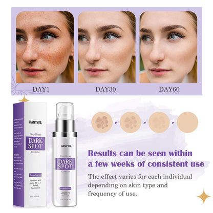 HANYWIL Dark Spot Remover for Face & Body Serum,Rapid Tone Repair Cream with Hyperpigmentation Treatment,Sun Spot, Age Spot & Melasma Remover,Dermatologist-Tested Brightening Retinol Serum (1.7 Fl Oz)