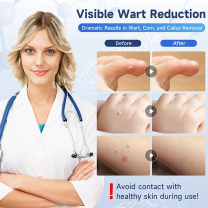 Fast-Acting Skin Tag Remover Wart Remover with Salicylic Acid, Wart Removal for Women Men, Wart Freeze Off for Plantar Wart, Flat, Common, Corn,H Wart, Callus 30ML