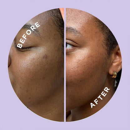 ZitSticka Hyperfade Microdart Pimple Patch, Targets Post-Zit Blemishes, Hydrates & Evens Skin Tone, With Hyaluronic Acid & Vitamin C for Clear, Smooth-Looking Skin (4 count)