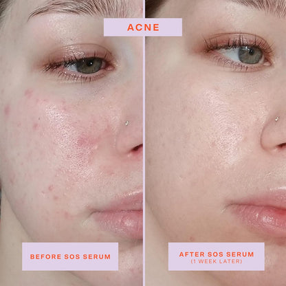 Tower 28 SOS Intensive Rescue Serum for Sensitive Skin, Hypochlorous Acid Skin Care, Helps Reduce Face Redness, Safe for All Skin Types, 2 FL Oz