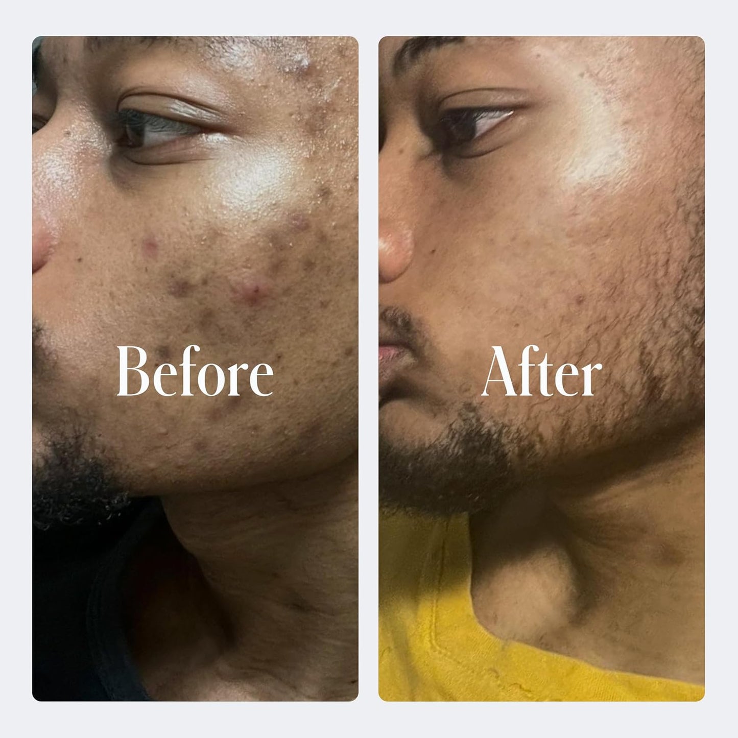 Geologie Clear System | 3-Step Acne Treatment & Skincare Set | Clears Skin Fast | Acne Gel Cleanser, SPF15 Day Cream & .3% Retinol Face Cream For Men & Women | Month 3+ / Level 3