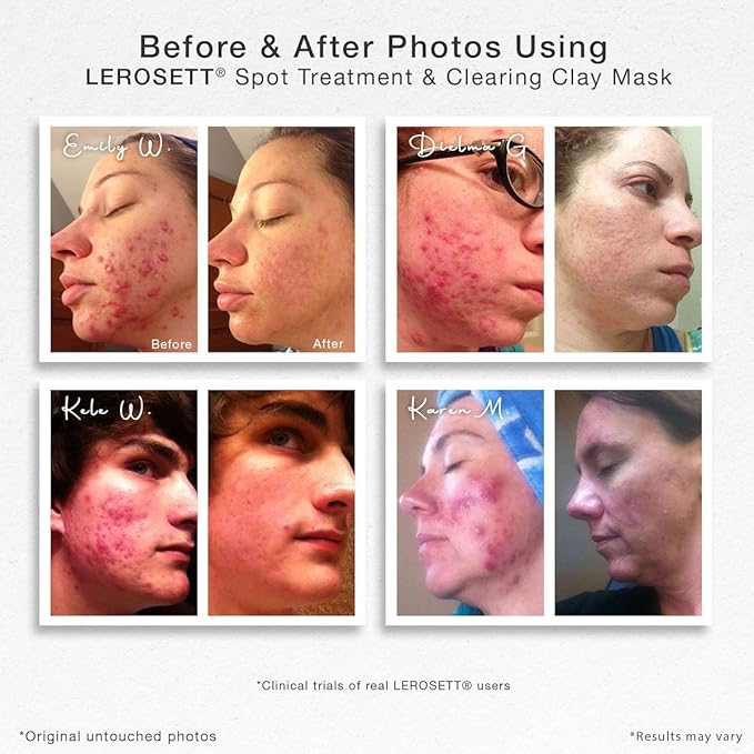 Lerosett facial clay for acne,