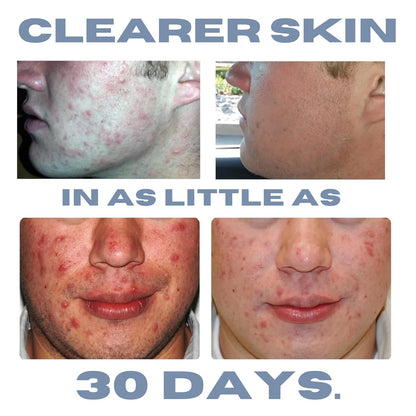 Acne Treatment Kit, Acne Kit, Skin Care Acne, Acne Skin Care Set, Natural Anti-DHT Deluxe Set Sensitive Skin 3-Piece Set, 2-Month Supply