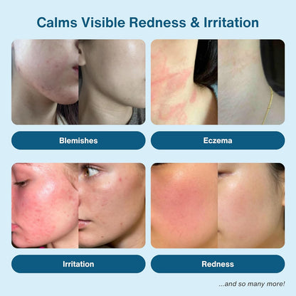 Hypochlorous Acid Spray – HOCl Face & Skin Mist for Acne, Eczema & Irritation – Multi-Purpose Skin Repair – Eyelid Cleanser, Post-Workout, Post-Procedure, Scalp & Sensitive Skin – 6.8 oz