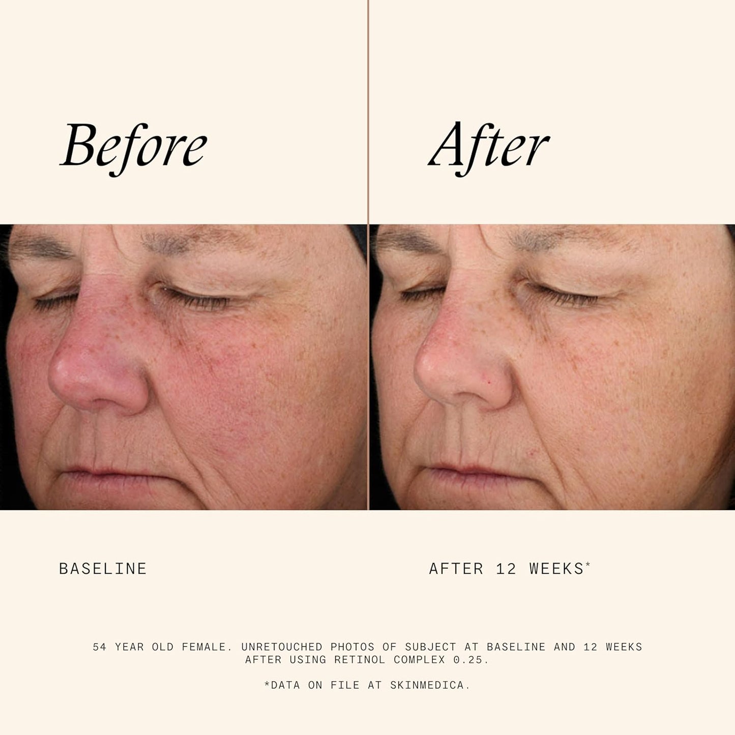 SkinMedica Retinol 0.25 Complex - Retinol Serum for Face, Age-Defying Advanced Retinol Cream That Renews Skin and Diminishes the Appearance of Fine Lines and Wrinkles, 1 Fl Oz