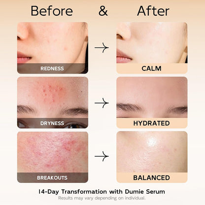 Azelaic Acid Serum 10%, Azelaic Acid for Face with Centella Asiatica Serum for Redness and Uneven Skin Tone, Hyaluronic Acid & Ceramide 3 – Soothes & Clears Pores for Sensitive Skin, 1.01 fl oz