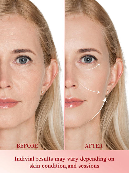 Radio Frequency Skin Tightening Device, Professional Wireless Home RF Skin Tightening Face Machine, 3 Levels for Smooth Fine Lines, Lifting, Firming