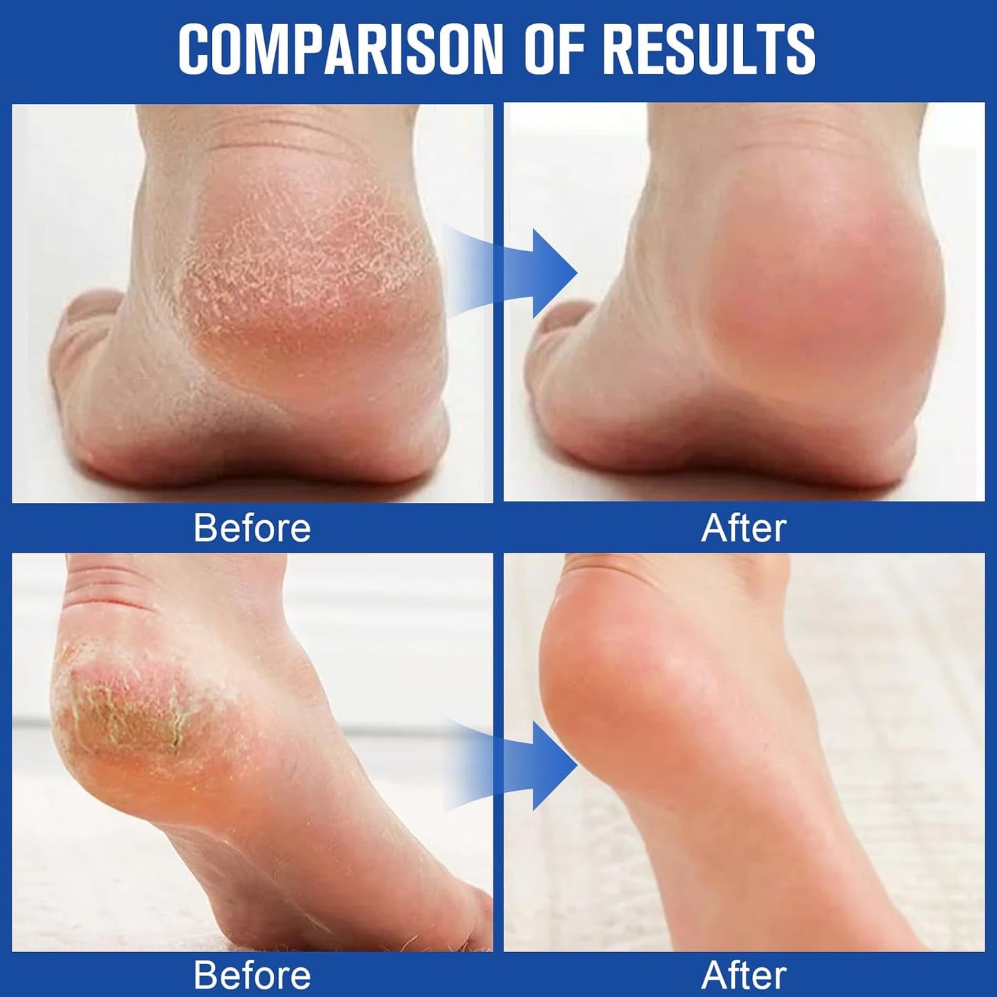 2PCS 60% Urea Hydrating and Anti-Cracking Foot Cream，2025 Upgraded Hand and Foot Cream Urea Moisturizer，Hydrates Dry and Cracked Feet and Hand (1.41 Ounce, White)