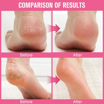 2PCS 60% Urea Hydrating and Anti-Cracking Foot Cream，2025 Upgraded Hand and Foot Cream Urea Moisturizer，Hydrates Dry and Cracked Feet and Hand (1.41 Ounce, Peach)